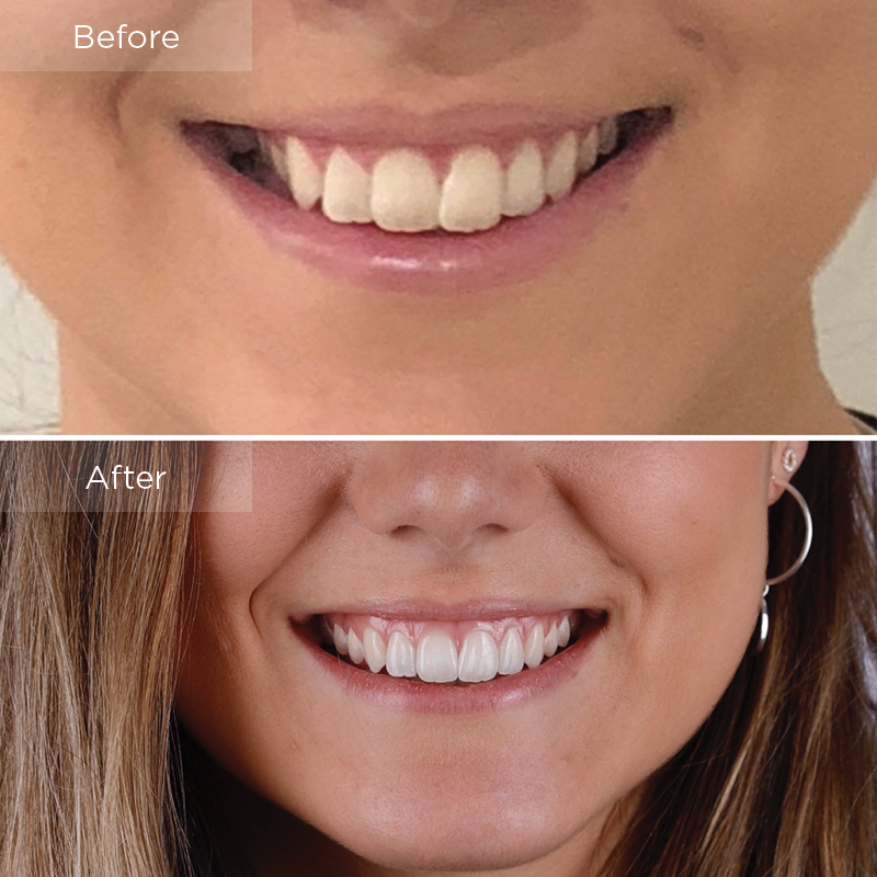 Invisalign43